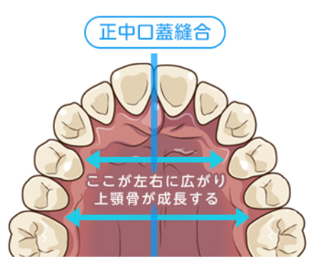 上顎拡大装置